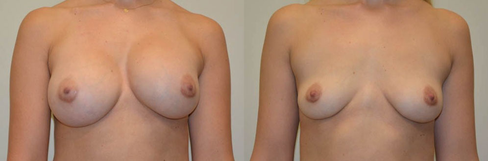 Breast Implant Removal Before & After Photos