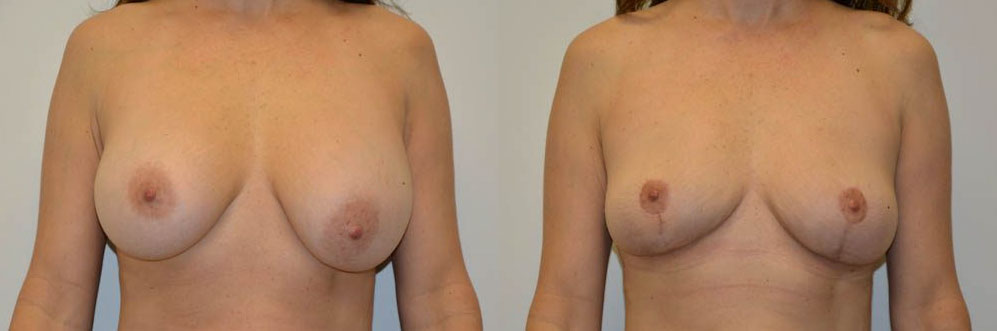 Breast Implant Removal Before & After Photos