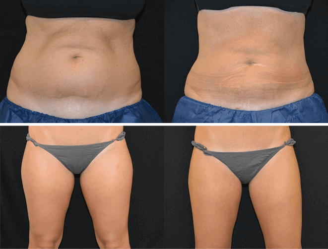 CoolSculpting® Patient Photos