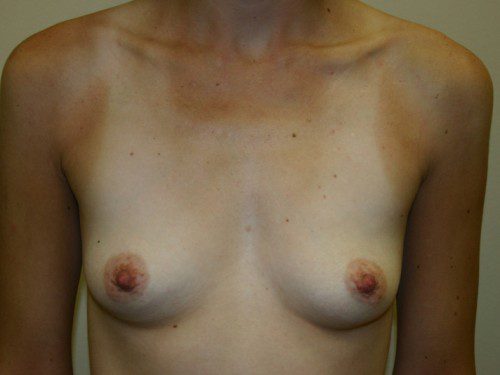 Breast Augmentation Before Patient 1