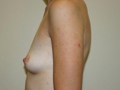 Breast Augmentation Before Patient 5