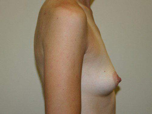 Breast Augmentation Before Patient 4