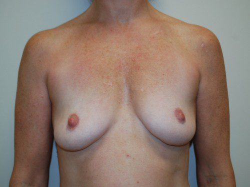 Breast Augmentation Before Patient 1
