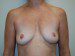 Breast Augmentation Before Patient Thumbnail 1