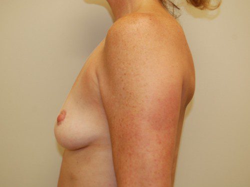 Breast Augmentation Before Patient 4