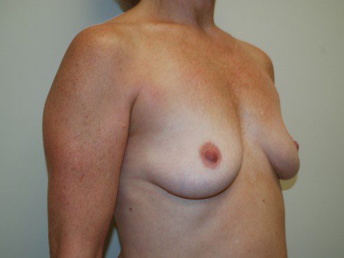 Breast Augmentation Before Patient 3