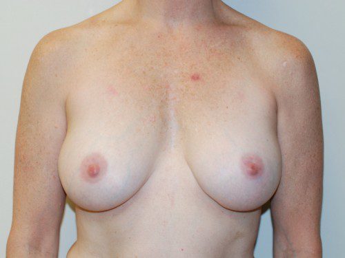 Breast Augmentation After Patient 1