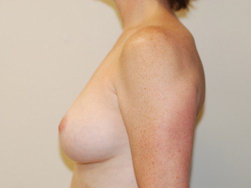 Breast Augmentation After Patient 4