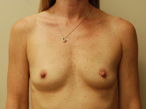 Breast Augmentation Before Patient 1