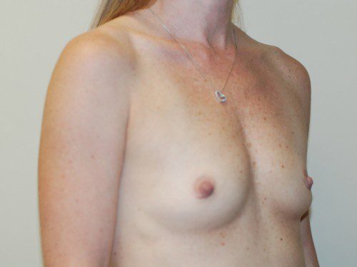 Breast Augmentation Before Patient 2