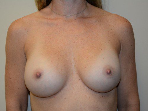 Breast Augmentation After Patient 1