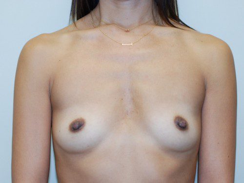 Breast Augmentation Before Patient 1