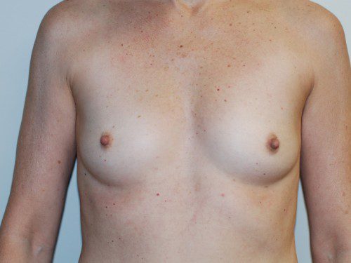 Breast Augmentation Before Patient 1