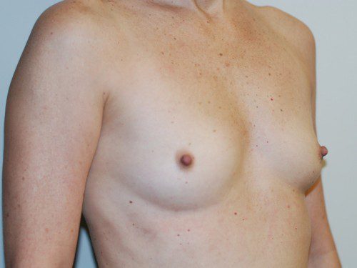 Breast Augmentation Before Patient 2