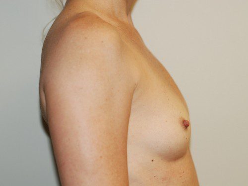 Breast Augmentation Before Patient 4