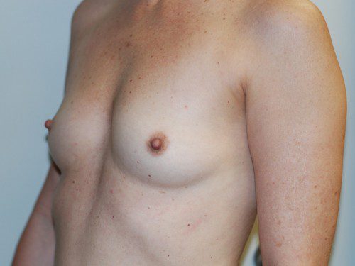 Breast Augmentation Before Patient 3