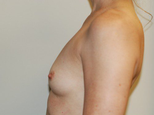 Breast Augmentation Before Patient 5