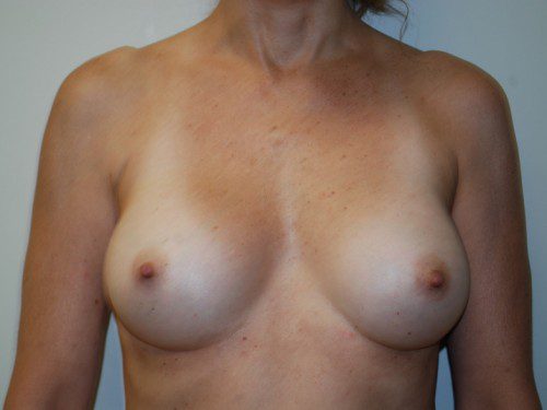 Breast Augmentation After Patient 1