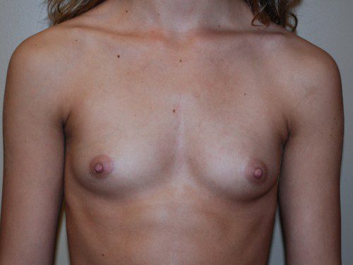 Breast Augmentation Before Patient 1