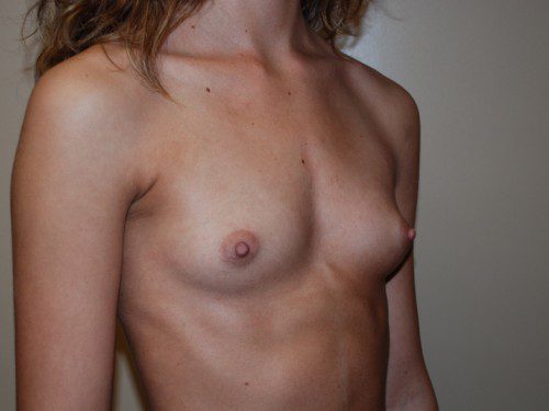 Breast Augmentation Before Patient 3