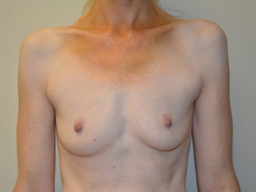 Breast Augmentation Before Patient 1