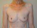 Breast Augmentation Before Patient Thumbnail 1