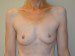 Breast Augmentation Before Patient Thumbnail 1