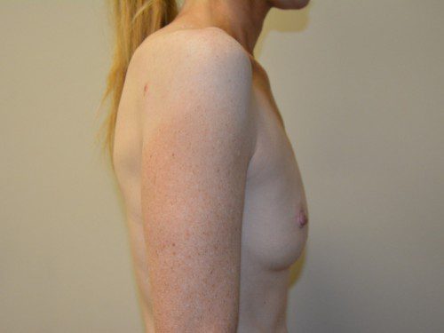 Breast Augmentation Before Patient 4