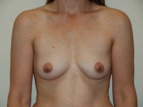 Breast Reconstruction Tissue Expanders Before Patient 1