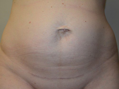 Tummy Tuck Before Patient 1