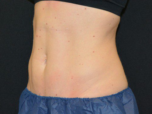 Coolsculpting Before Patient 2