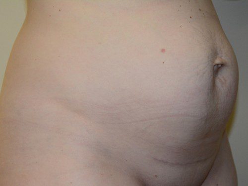 Tummy Tuck Before Patient 2