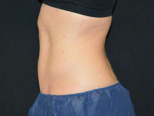 Coolsculpting Before Patient 4