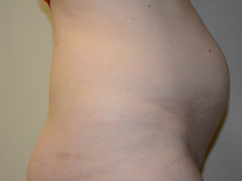 Tummy Tuck Before Patient 4