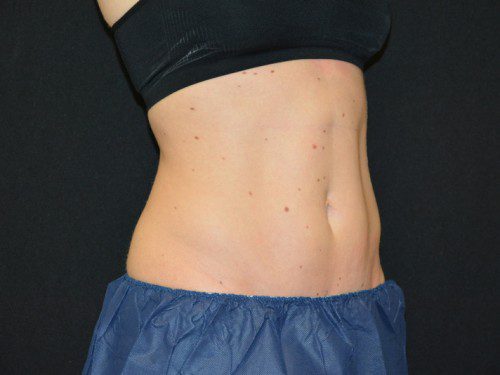Coolsculpting Before Patient 3