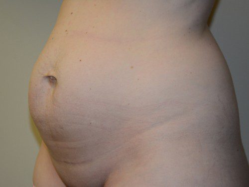 Tummy Tuck Before Patient 3