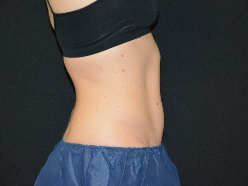 Coolsculpting Before Patient 5