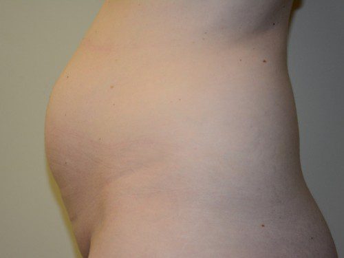 Tummy Tuck Before Patient 5