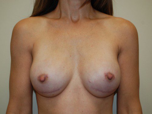 Breast Reconstruction Tissue Expanders After Patient 1