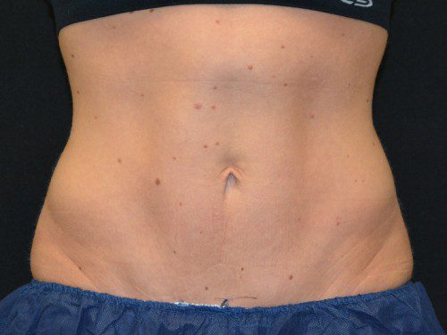 Coolsculpting After Patient 1