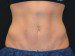 Coolsculpting After Patient Thumbnail 1