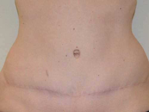 Tummy Tuck After Patient 1