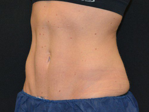 Coolsculpting After Patient 2