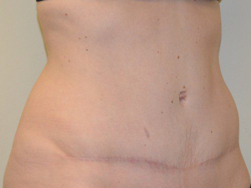 Tummy Tuck After Patient 2