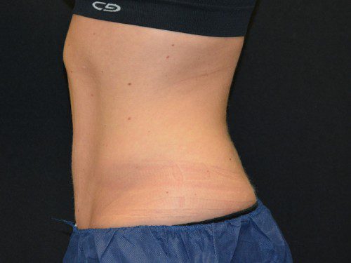 Coolsculpting After Patient 4