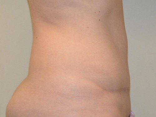 Tummy Tuck After Patient 4