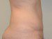 Tummy Tuck After Patient Thumbnail 4