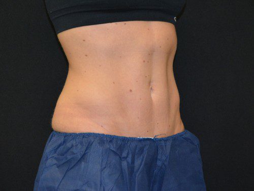 Coolsculpting After Patient 3