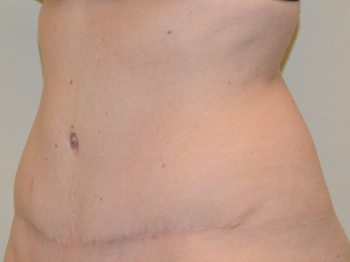 Tummy Tuck After Patient 3