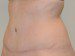 Tummy Tuck After Patient Thumbnail 3